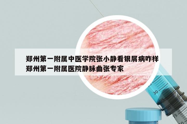郑州第一附属中医学院张小静看银屑病咋样 郑州第一附属医院静脉曲张专家