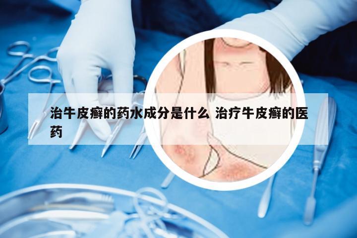 治牛皮癣的药水成分是什么 治疗牛皮癣的医药