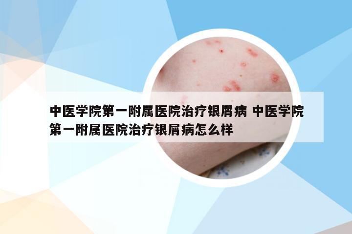 中医学院第一附属医院治疗银屑病 中医学院第一附属医院治疗银屑病怎么样