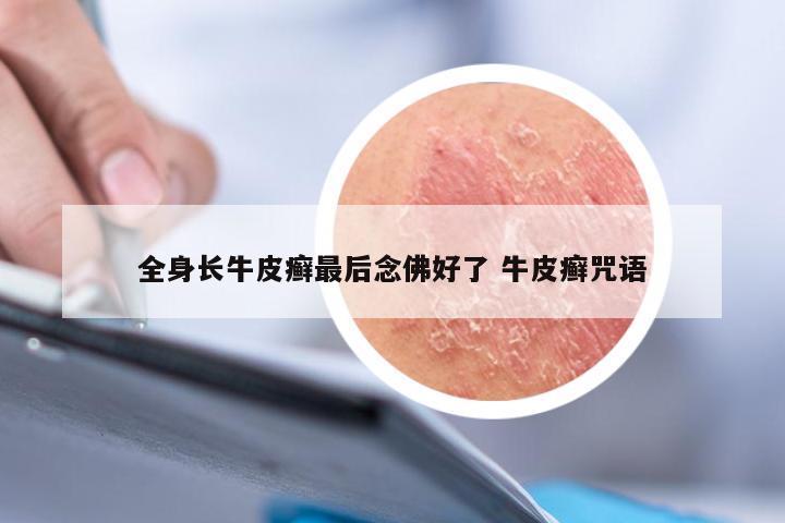 全身长牛皮癣最后念佛好了 牛皮癣咒语