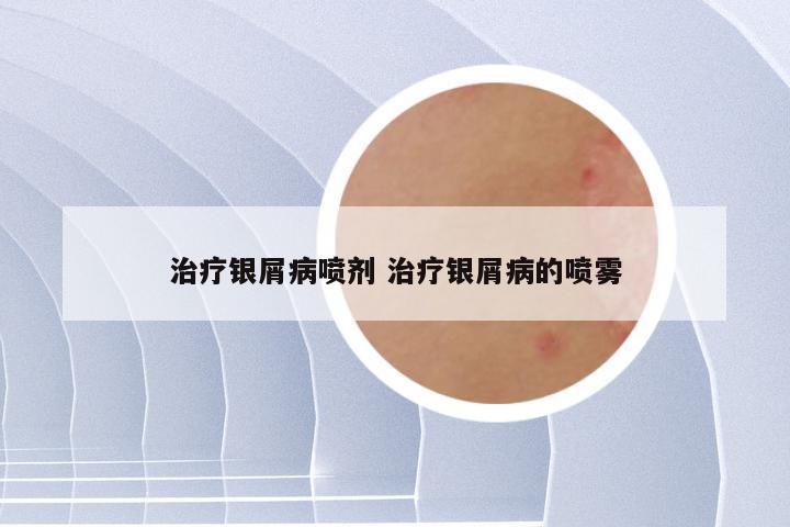治疗银屑病喷剂 治疗银屑病的喷雾