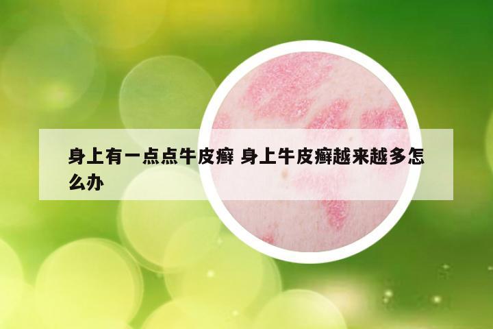 身上有一点点牛皮癣 身上牛皮癣越来越多怎么办