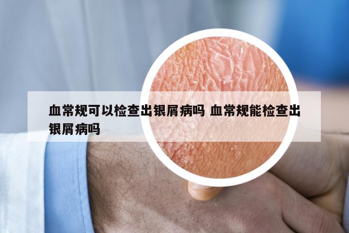 血常规可以检查出银屑病吗 血常规能检查出银屑病吗