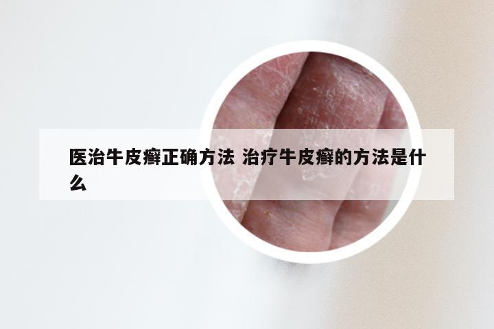 医治牛皮癣正确方法 治疗牛皮癣的方法是什么