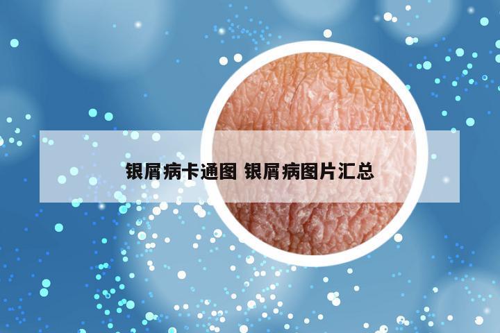 银屑病卡通图 银屑病图片汇总