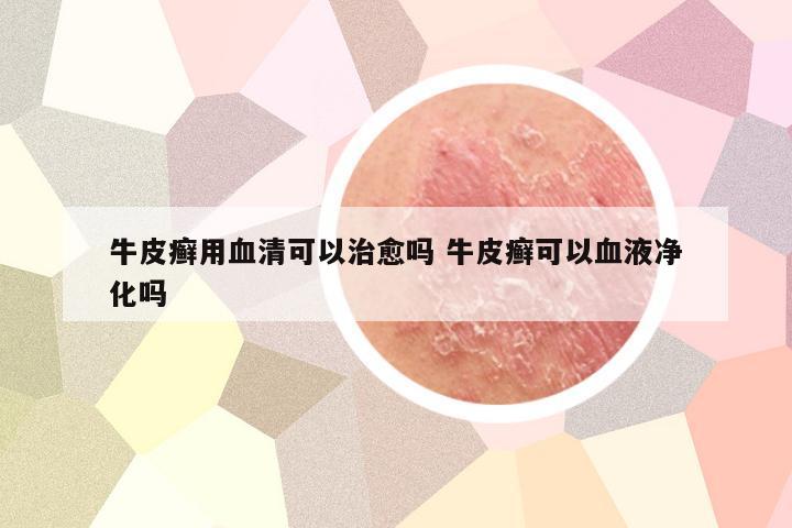 牛皮癣用血清可以治愈吗 牛皮癣可以血液净化吗