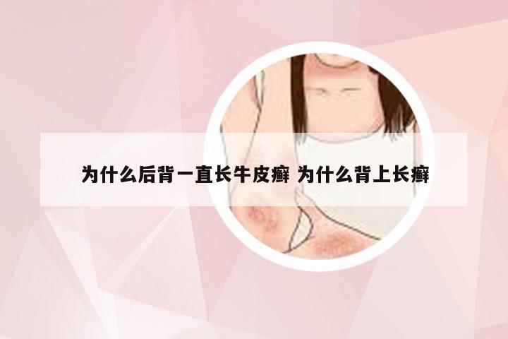 为什么后背一直长牛皮癣 为什么背上长癣