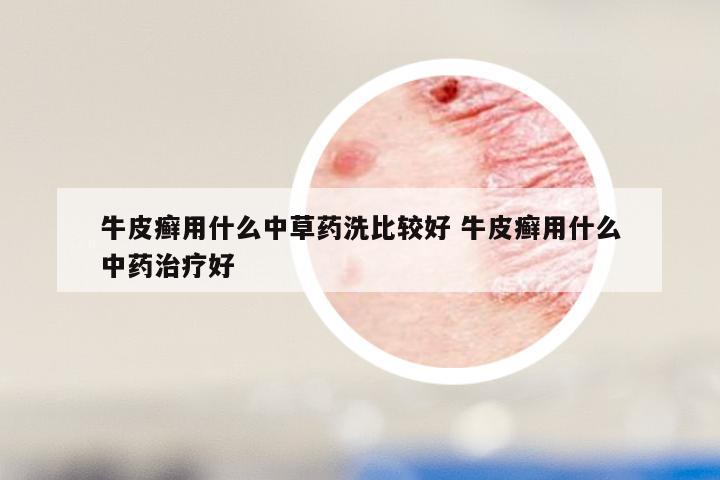 牛皮癣用什么中草药洗比较好 牛皮癣用什么中药治疗好