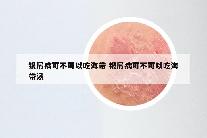 银屑病可不可以吃海带 银屑病可不可以吃海带汤