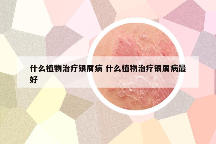 什么植物治疗银屑病 什么植物治疗银屑病最好