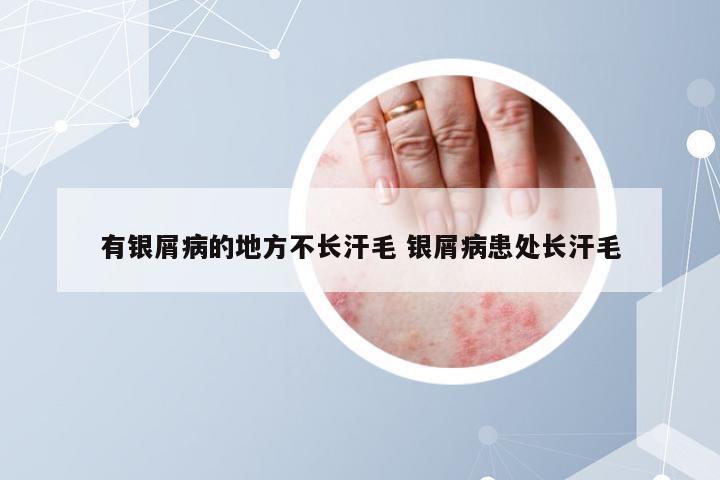 有银屑病的地方不长汗毛 银屑病患处长汗毛