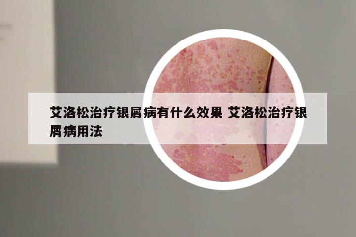 艾洛松治疗银屑病有什么效果 艾洛松治疗银屑病用法