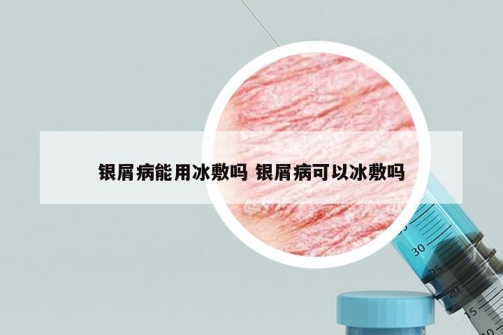 银屑病能用冰敷吗 银屑病可以冰敷吗