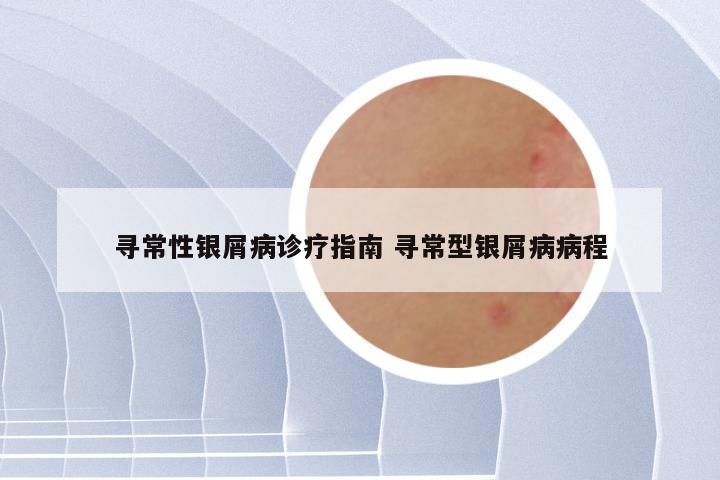 寻常性银屑病诊疗指南 寻常型银屑病病程