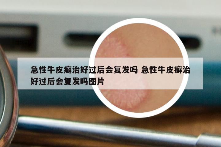 急性牛皮癣治好过后会复发吗 急性牛皮癣治好过后会复发吗图片