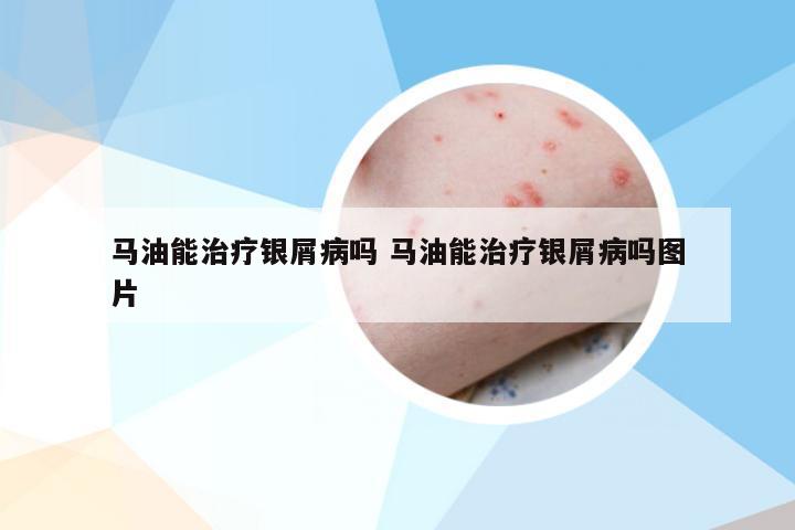 马油能治疗银屑病吗 马油能治疗银屑病吗图片