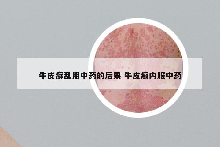 牛皮癣乱用中药的后果 牛皮癣内服中药
