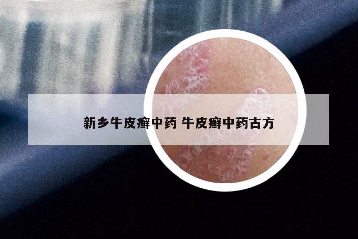 新乡牛皮癣中药 牛皮癣中药古方