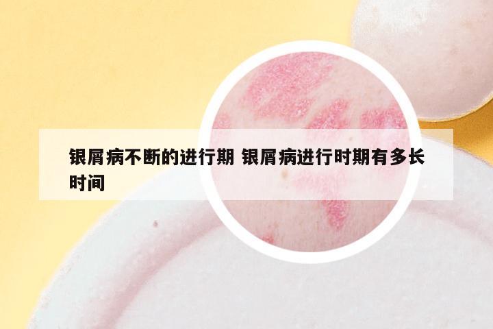 银屑病不断的进行期 银屑病进行时期有多长时间