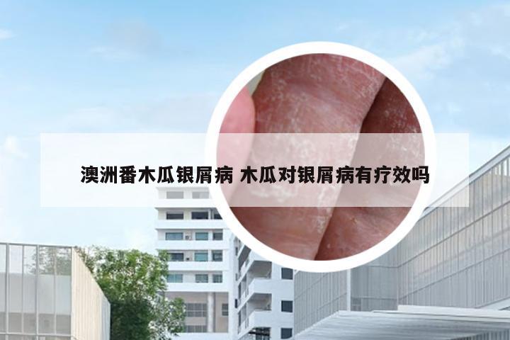 澳洲番木瓜银屑病 木瓜对银屑病有疗效吗