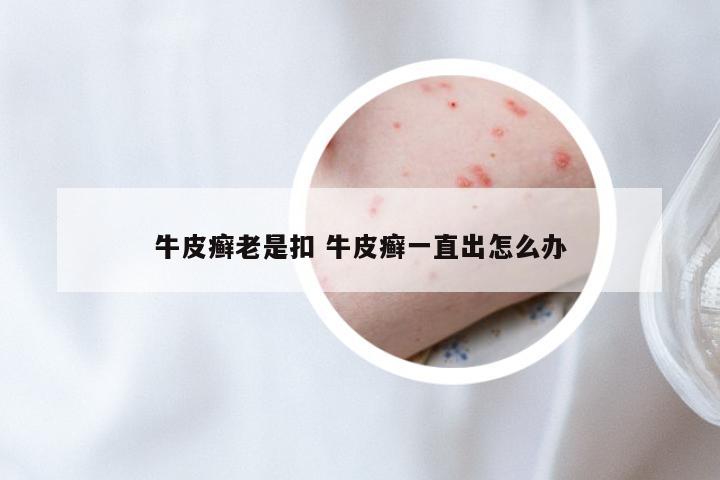 牛皮癣老是扣 牛皮癣一直出怎么办