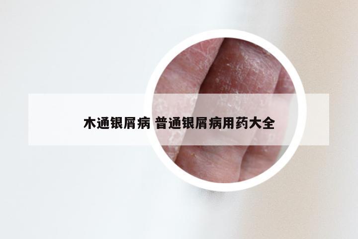 木通银屑病 普通银屑病用药大全