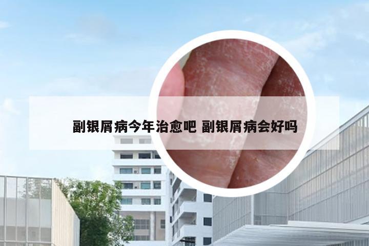 副银屑病今年治愈吧 副银屑病会好吗