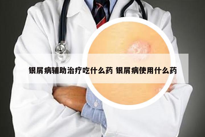 银屑病辅助治疗吃什么药 银屑病使用什么药