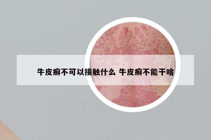 牛皮癣不可以接触什么 牛皮癣不能干啥