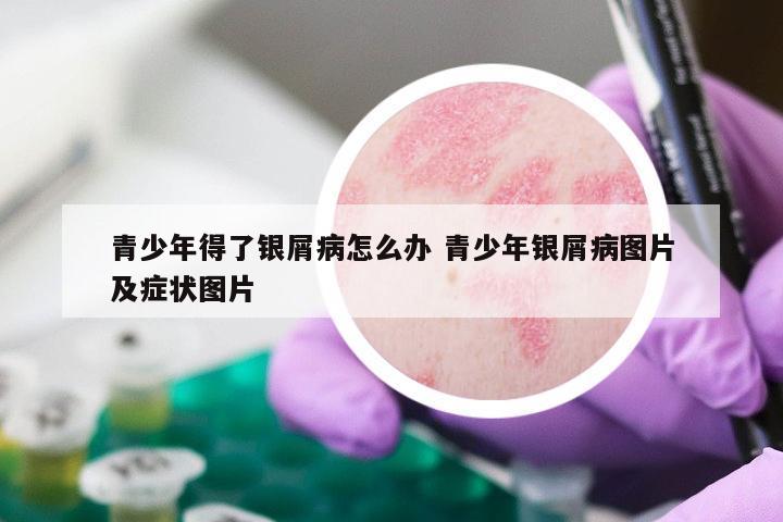 青少年得了银屑病怎么办 青少年银屑病图片及症状图片
