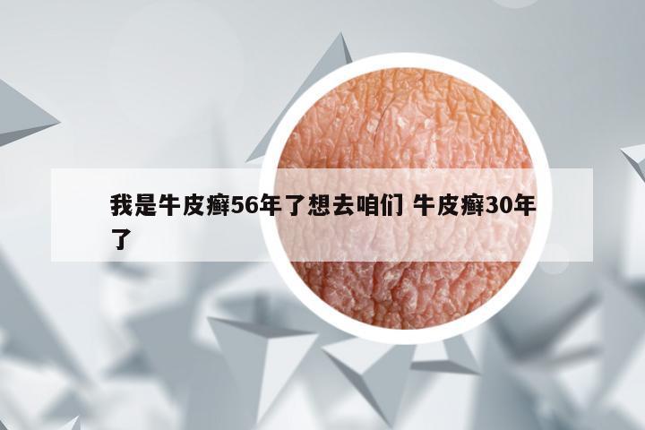 我是牛皮癣56年了想去咱们 牛皮癣30年了