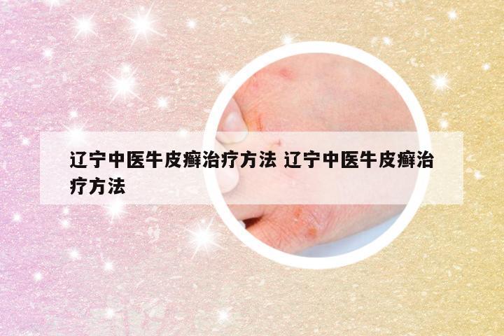 辽宁中医牛皮癣治疗方法 辽宁中医牛皮癣治疗方法