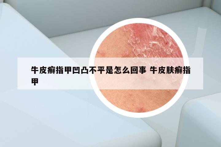 牛皮癣指甲凹凸不平是怎么回事 牛皮肤癣指甲