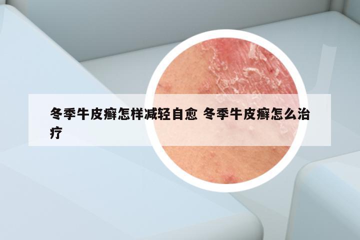 冬季牛皮癣怎样减轻自愈 冬季牛皮癣怎么治疗
