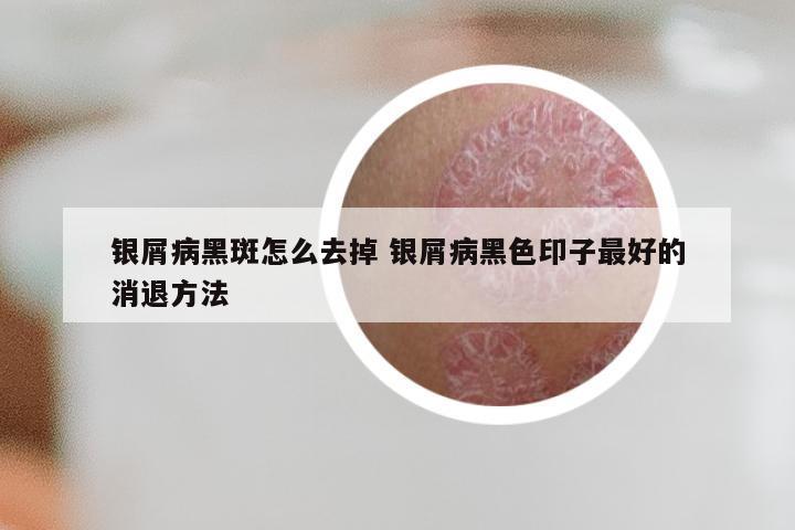 银屑病黑斑怎么去掉 银屑病黑色印子最好的消退方法