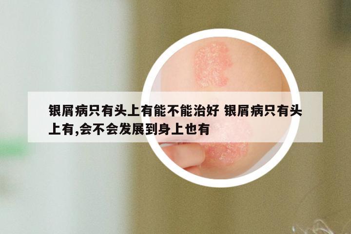 银屑病只有头上有能不能治好 银屑病只有头上有,会不会发展到身上也有
