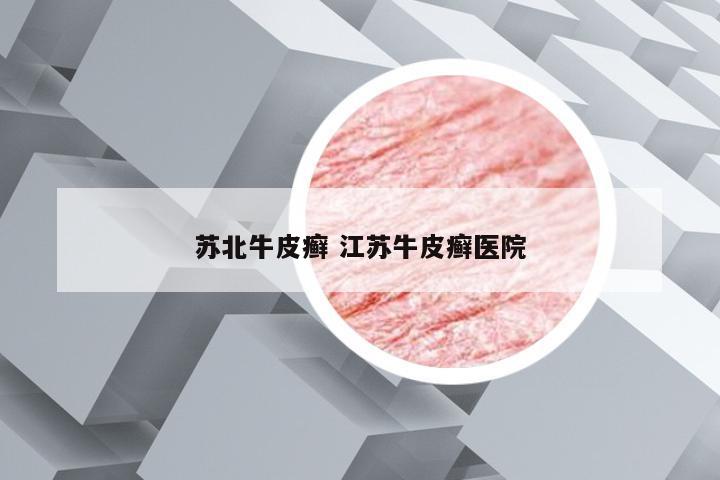 苏北牛皮癣 江苏牛皮癣医院