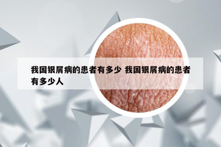 我国银屑病的患者有多少 我国银屑病的患者有多少人