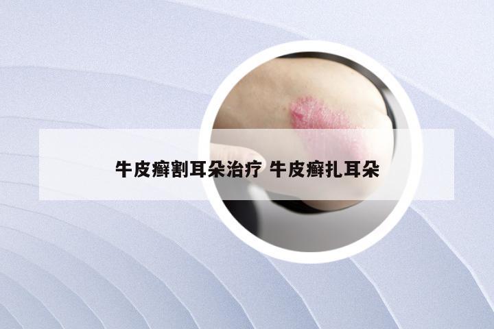 牛皮癣割耳朵治疗 牛皮癣扎耳朵