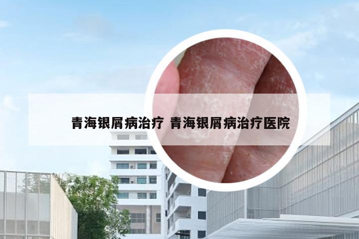 青海银屑病治疗 青海银屑病治疗医院