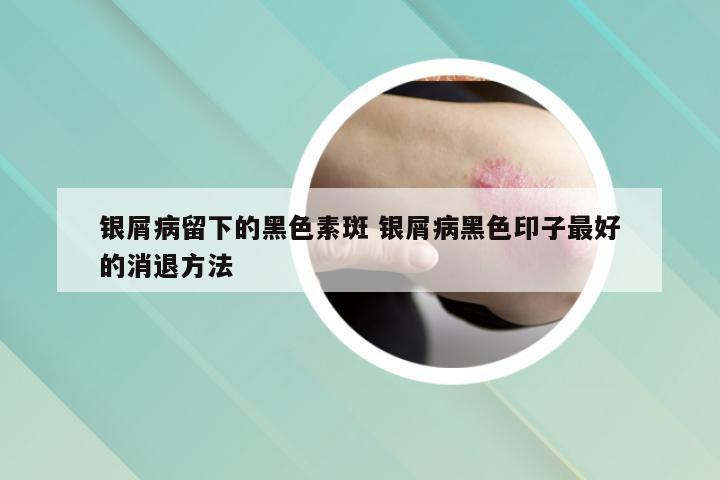 银屑病留下的黑色素斑 银屑病黑色印子最好的消退方法