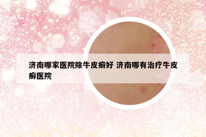 济南哪家医院除牛皮癣好 济南哪有治疗牛皮癣医院