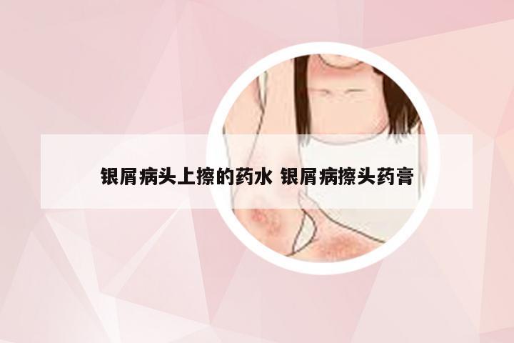 银屑病头上擦的药水 银屑病擦头药膏