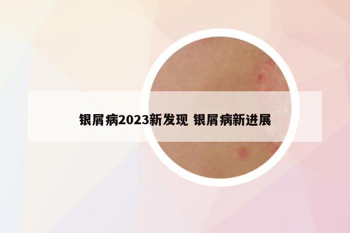 银屑病2023新发现 银屑病新进展