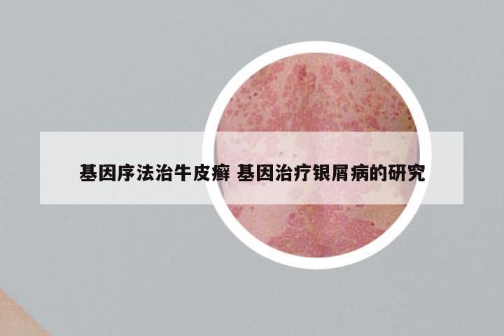基因序法治牛皮癣 基因治疗银屑病的研究