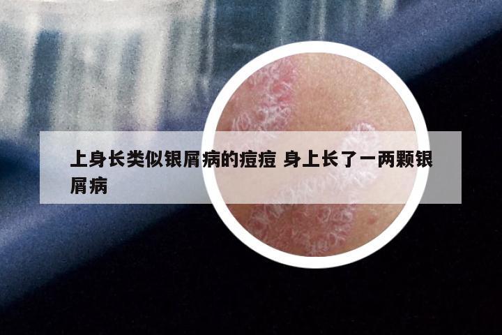 上身长类似银屑病的痘痘 身上长了一两颗银屑病