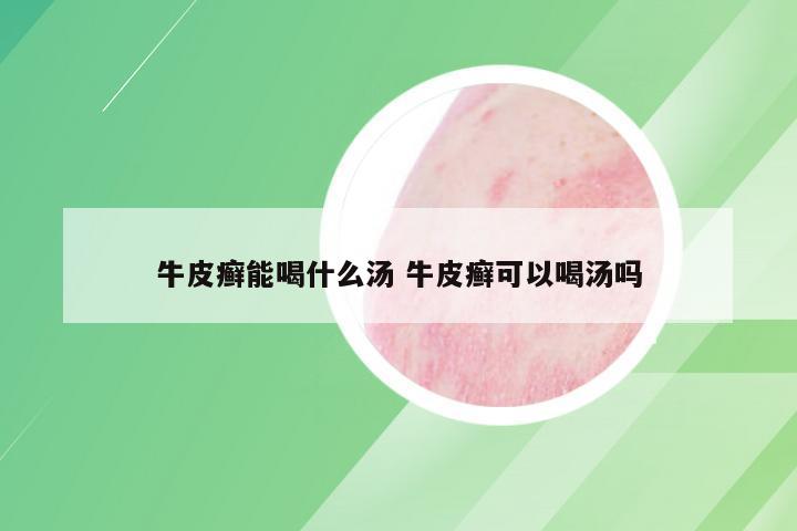 牛皮癣能喝什么汤 牛皮癣可以喝汤吗