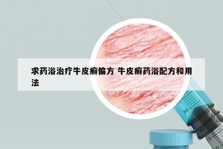 求药浴治疗牛皮癣偏方 牛皮癣药浴配方和用法