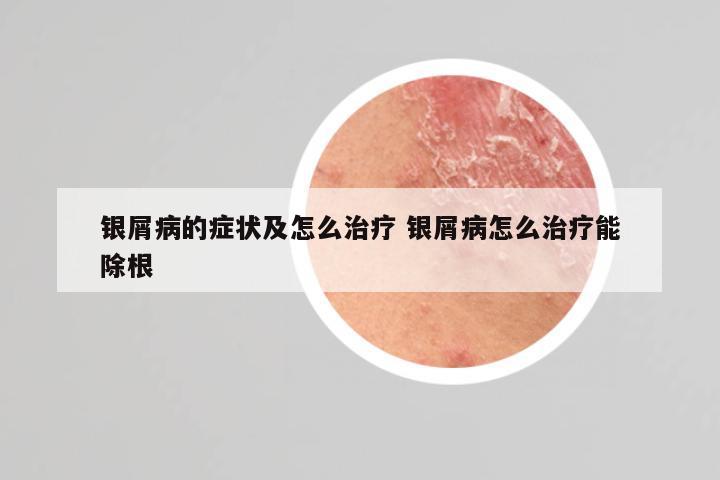 银屑病的症状及怎么治疗 银屑病怎么治疗能除根