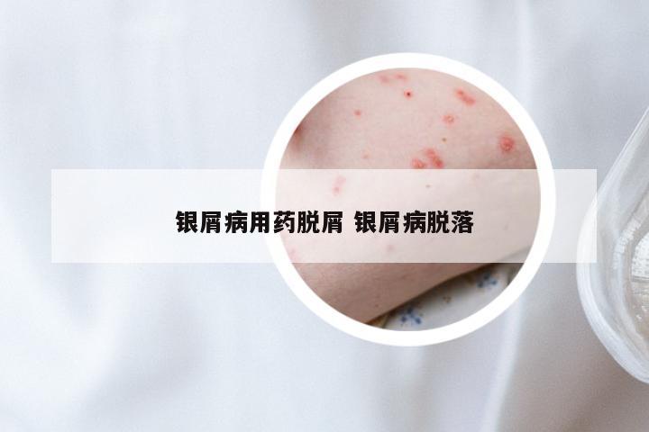 银屑病用药脱屑 银屑病脱落